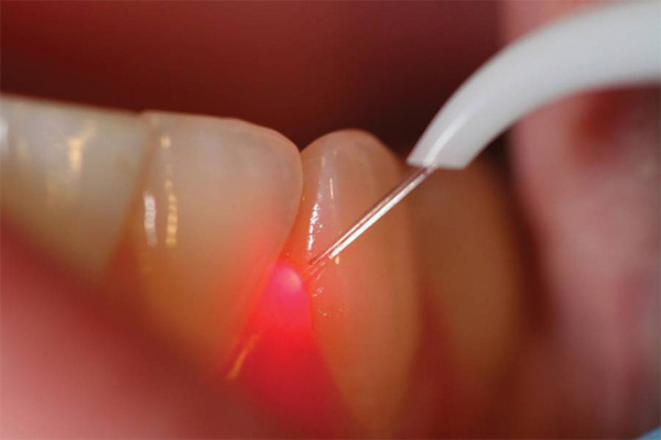 Laser Bloodless and Painless Dental Treatment